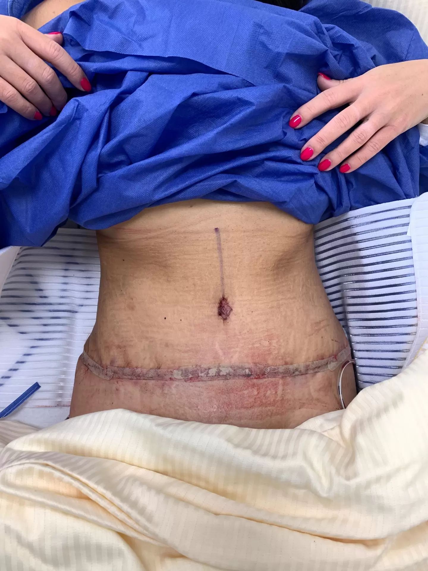 Traumhaft schönes Ergebnis nach Bauchdeckenstraffung Estheticon.de